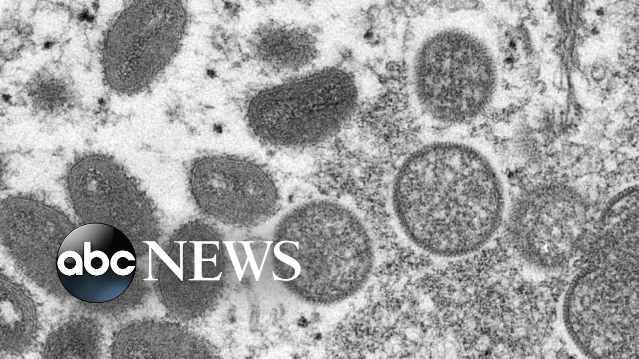 7 people in the US confirmed or presumed to have monkeypox in 5 states l ABCNL