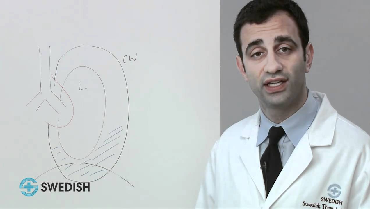 mesothelioma types and symptoms