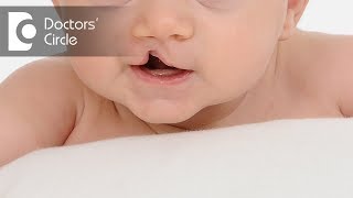 What is Cleft Lip & Palate? - Dr. Srikanth V
