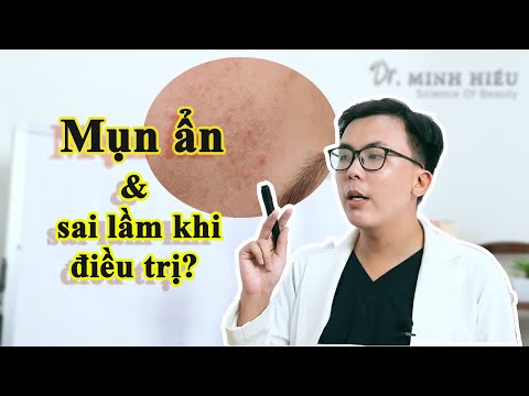 MỤN ẨN và những 