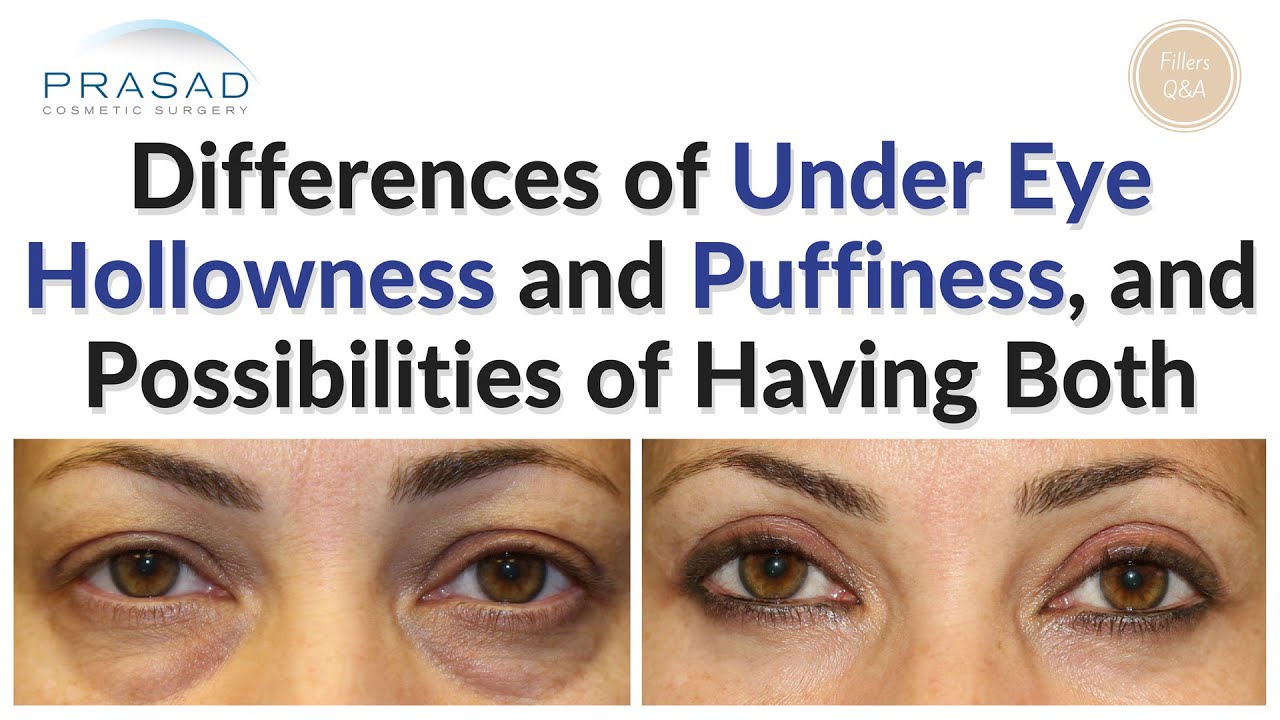 Hereditary eye bags - the science and theory of outsmarting eyelid genes -  Dr. Brett Kotlus