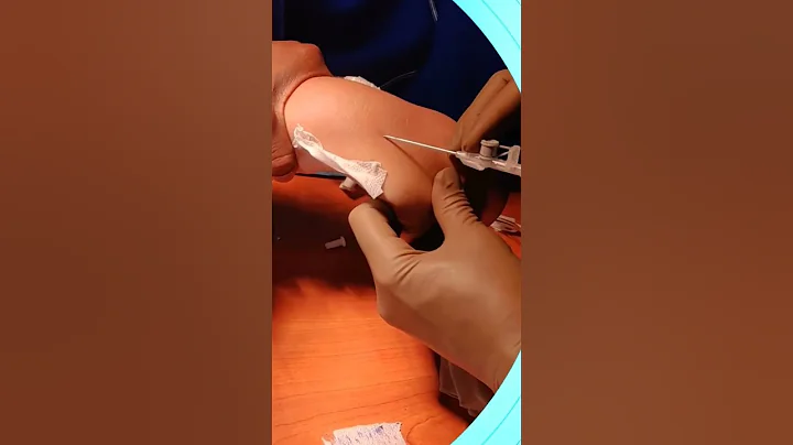 Feel the vein if not seen during iv line insertion.