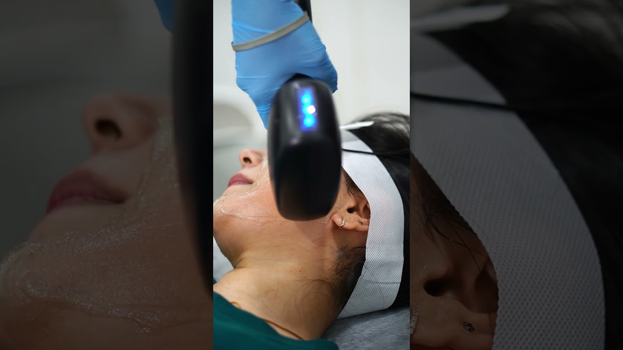 Facial Laser Hair Removal procedure at Maynee Skin Clinic Chennai — click to play