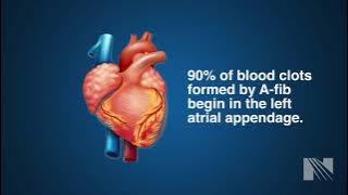 Watchman Procedure for Left Atrial Appendage Occlusion (LAAO)