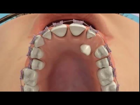 Неровные зубы - это не катострофа