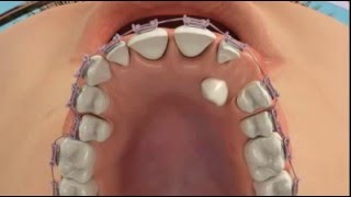 Неровные зубы - это не катострофа Неровные зубы - это не катострофа