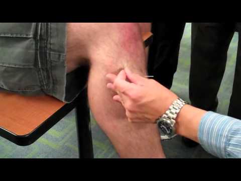 McMaster Medical Acupuncture Program: Acupuncture Point GB 34