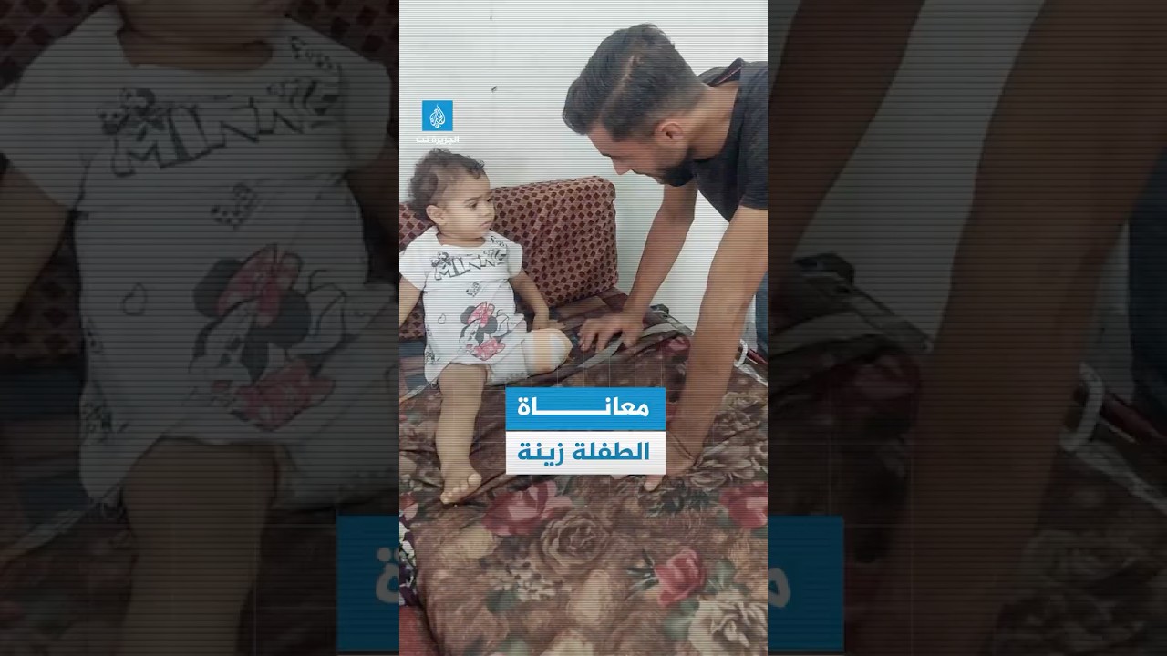 معاناة الطفلة زينة بعد بتر ساقها إثر إصابتها بشظية اخترقت خيمتها
