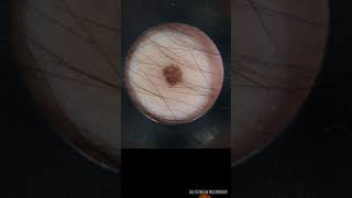 Android Application for Real Time Inference of Skin Lesions screenshot 3