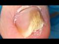 Regular Toenails Get Bad, Cut The Fungus Off!#duet #satisfying #relax #nails