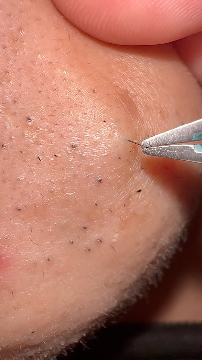 A Light Daily Beard Care Session #hairremoval #plucking #tweezers #routines #satisfying