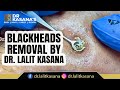 Blackhead removal dr lalit kasana  blackhead removal on face  this week 2022  part 6