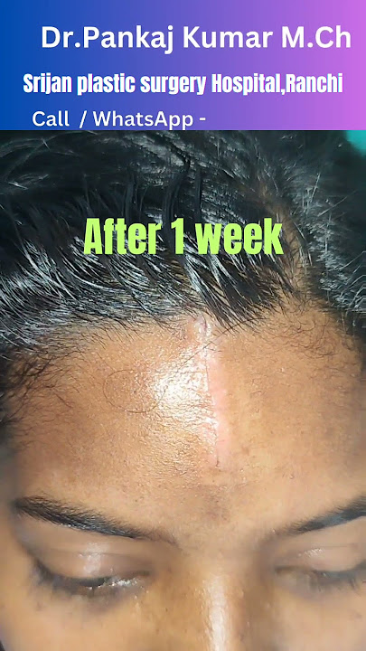 Scar revision surgery| scar treatment| #shorts #youtubeshorts