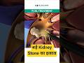 Treatment for large Kidney Stone | बड़ी पथरी का इलाज | PCNL क्या है? #pcnl #kidneystone