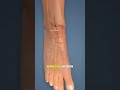 Ankle replacement surgery (3D animation)