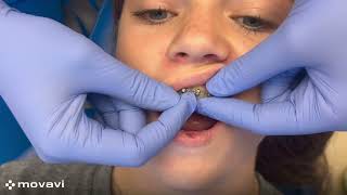 Braces Hack – Closing an Open Bracket Door