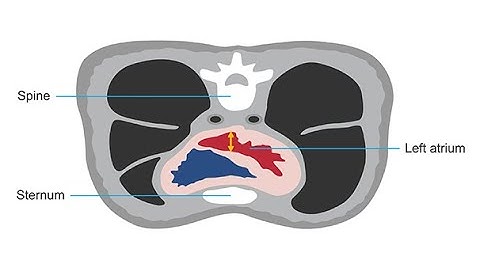 Assessing the left atrium using 3D echocardiography