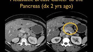 Pitfalls and Pearls in the CT Diagnosis of Pancreatic Cancer: Lessons Learned