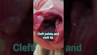 cleft palate and cleft lip happens when mother is deficient in folate.#shortsyoutube