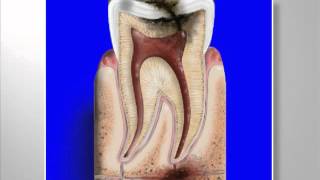 Caries and Root Canal Therapy By West Palm Beach Dentist Carlos Boudet DDS