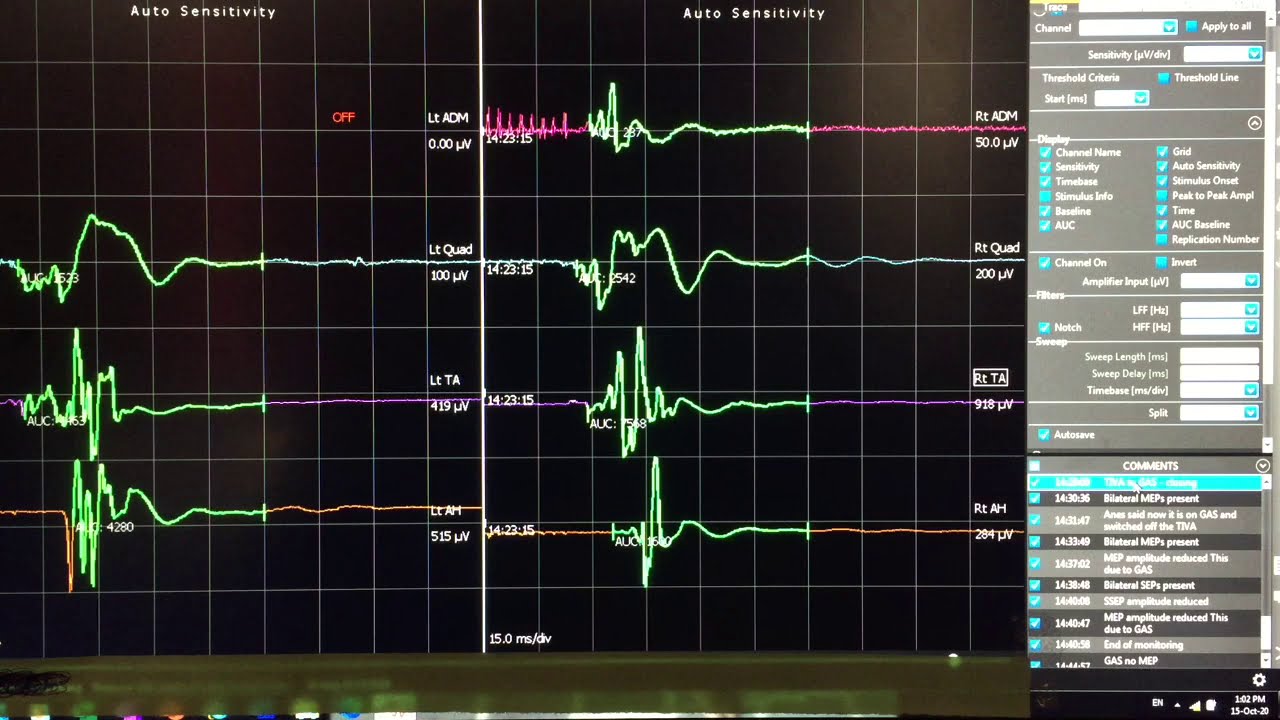 Neuromonitoring MEP Changes / TIVA to GAS / Motor Evoked Potential ...