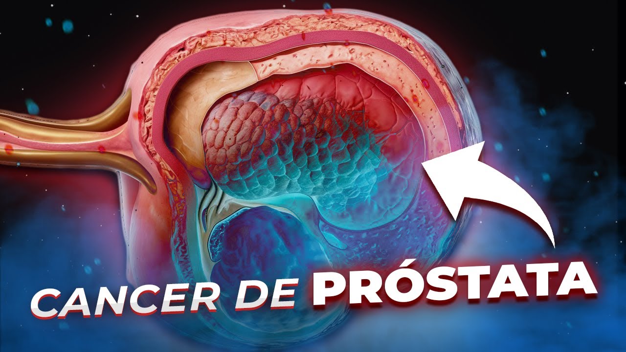 CANCER De PROSTATA Para Pacientes | Explicado FACIL