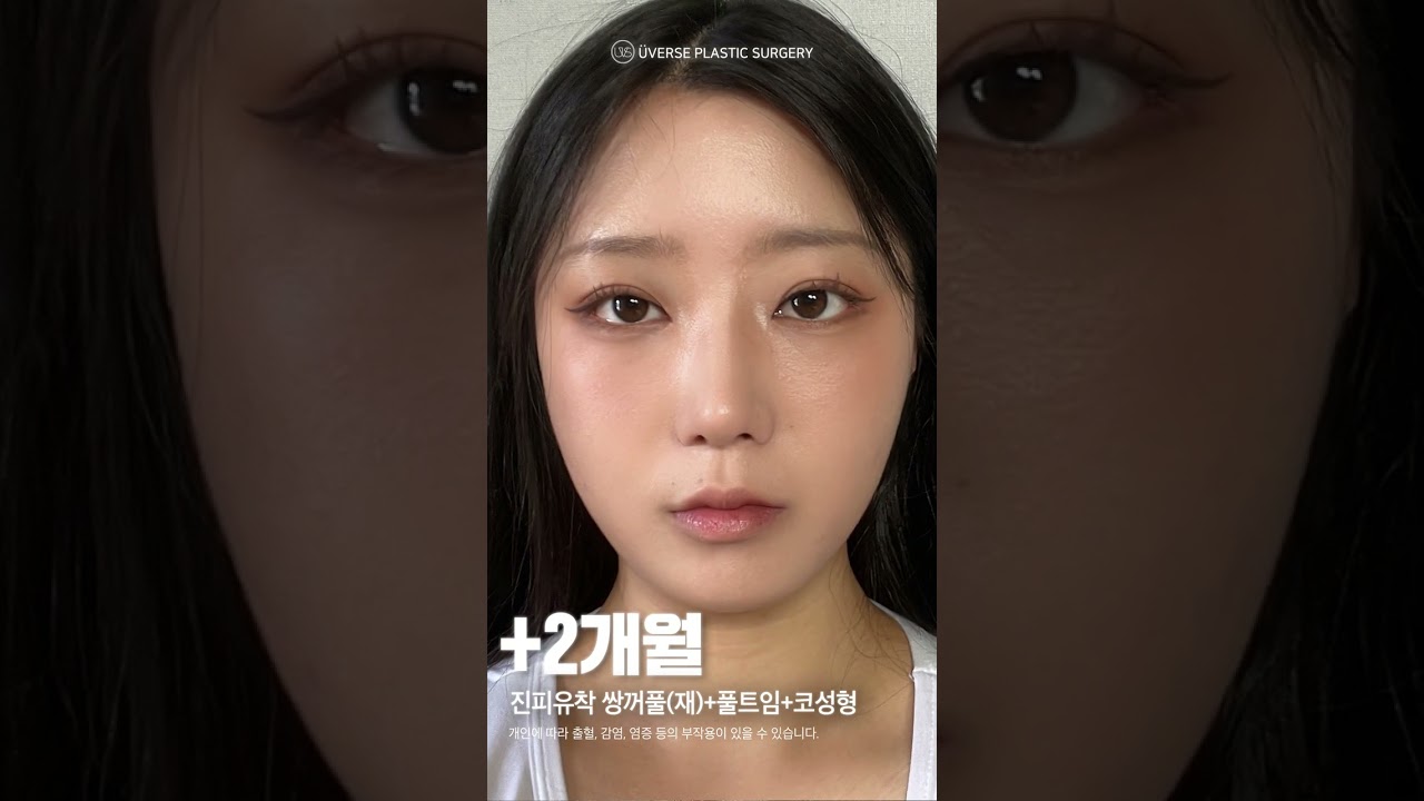 [Вэвэрс Гоо сайхны мэс заслын эмнэлэг] Би хөөрхөн учраас! Вэвэрс #богино_видео #арьсны_наалдуулах_давхар_зовхи #бүрэн_тэлэлт #хамар_засал