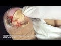 甲溝炎-paronychia 베트남/realxing video 111/涷甲/嵌甲/Ingrown nail treatment（how to fix ingrown toenail）