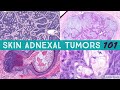 Skin adnexal tumors 101 a basic approach for general pathologists