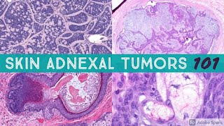 Skin Adnexal Tumors 101: A Basic Approach for General Pathologists screenshot 5