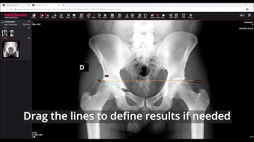 MedDream DICOM Viewer: show angles tool