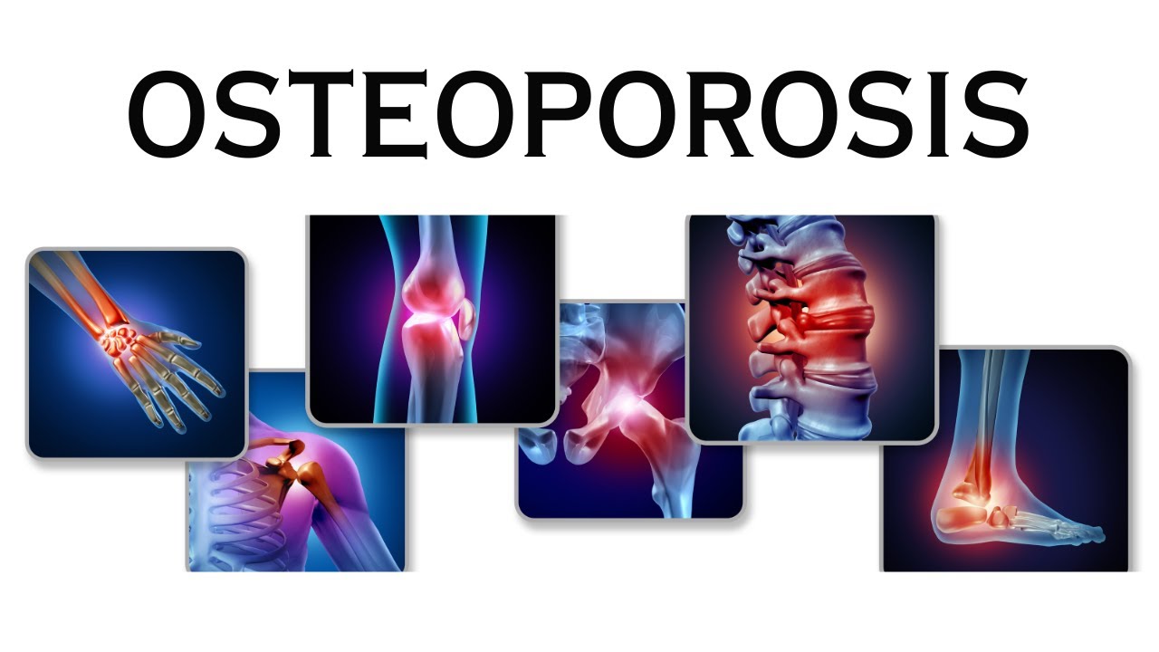 Prevent or Reverse Osteoporosis - YouTube