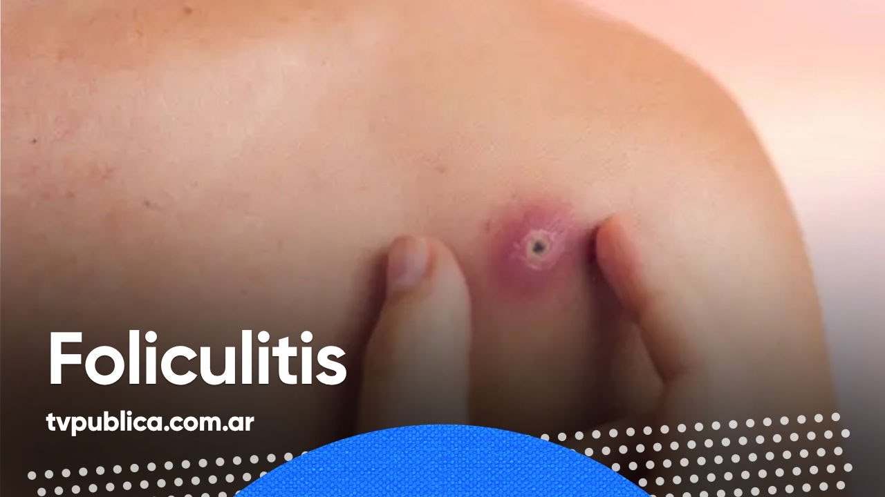 Tratamiento y prevencion de la foliculitis En Casa Salud