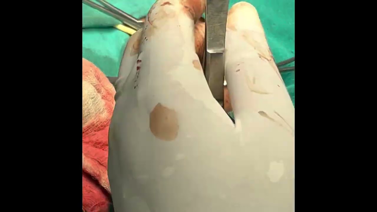 ASARP (anterior sagittal anorectoplasty) for Anovestibular fistula in 6month old female