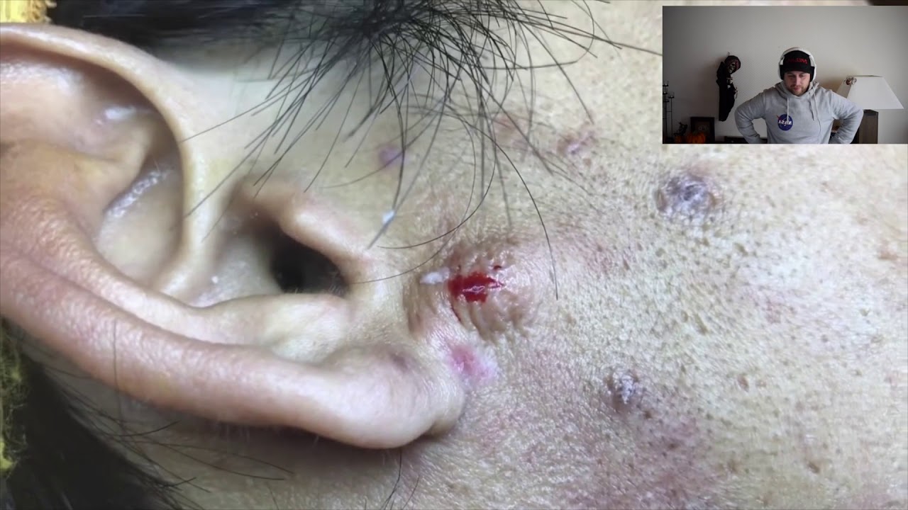 Cyst Explosion On The Ear And Explodes On Camera Youtube