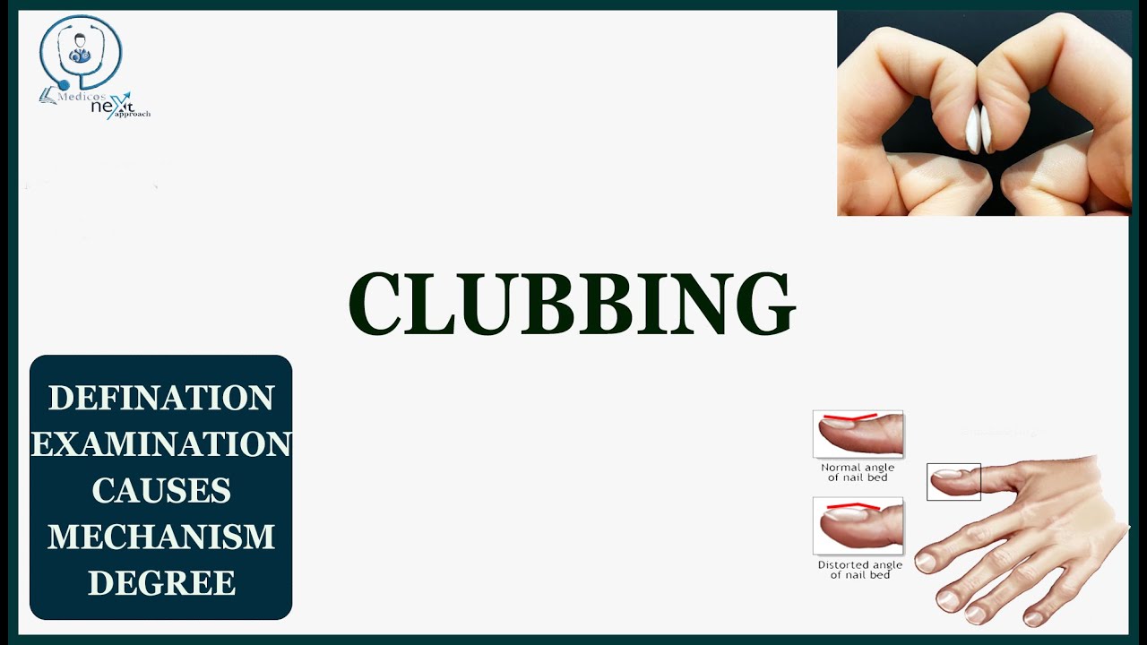 Clubbing medicine practical NEXT PG YouTube