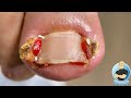 WHAT HAPPENS WHEN YOU DON’T TREAT AN INGROWN TOENAIL??? ***WARNING: VERY GRAPHIC***