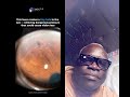 Laser iridotomy is a quick eye procedure where a precise laser creates a tiny opening in the iris.