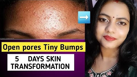 5 Days Skin Transformation Challenge: Remove Tiny Bumbs open pores closed pores in just 5 days