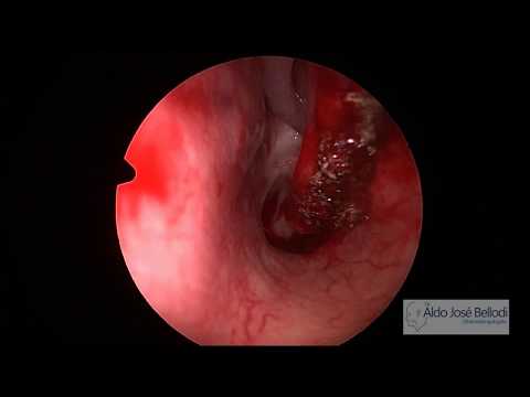 Vídeo: Turbinectomia: Procedimento E Acompanhamento