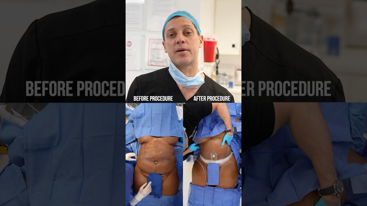 BEFORE & AFTER | 360 Lipo, BBL, Tummy Tuck 