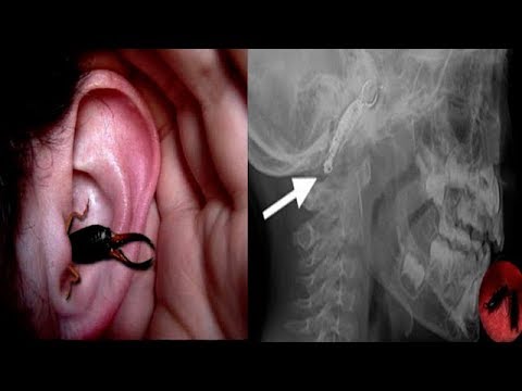 Video: Earwig Bite: I Dit øre, Symptomer Og Billeder