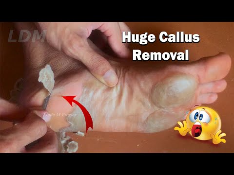 Callus Removal From Feet - 足からのカルス除去＃65