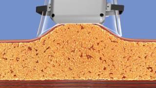 Cryolipolyse   Lipocryolyse   Coolsculpting