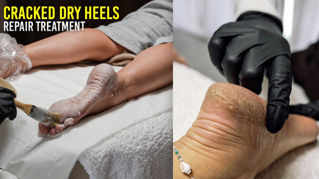 Satisfying Hard Skin Removal & Relaxing Paraffin Wax Treatment 