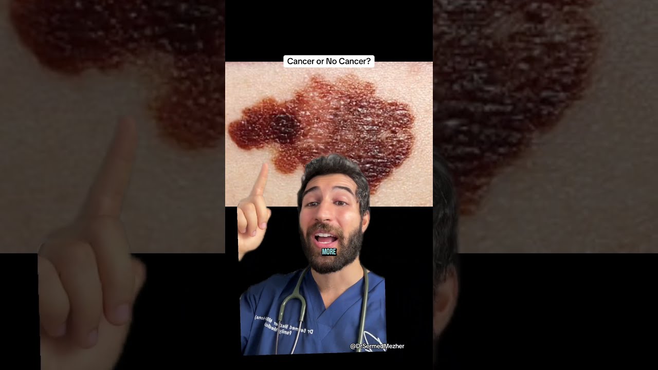 Are These 5 Moles Dangerous Challenge