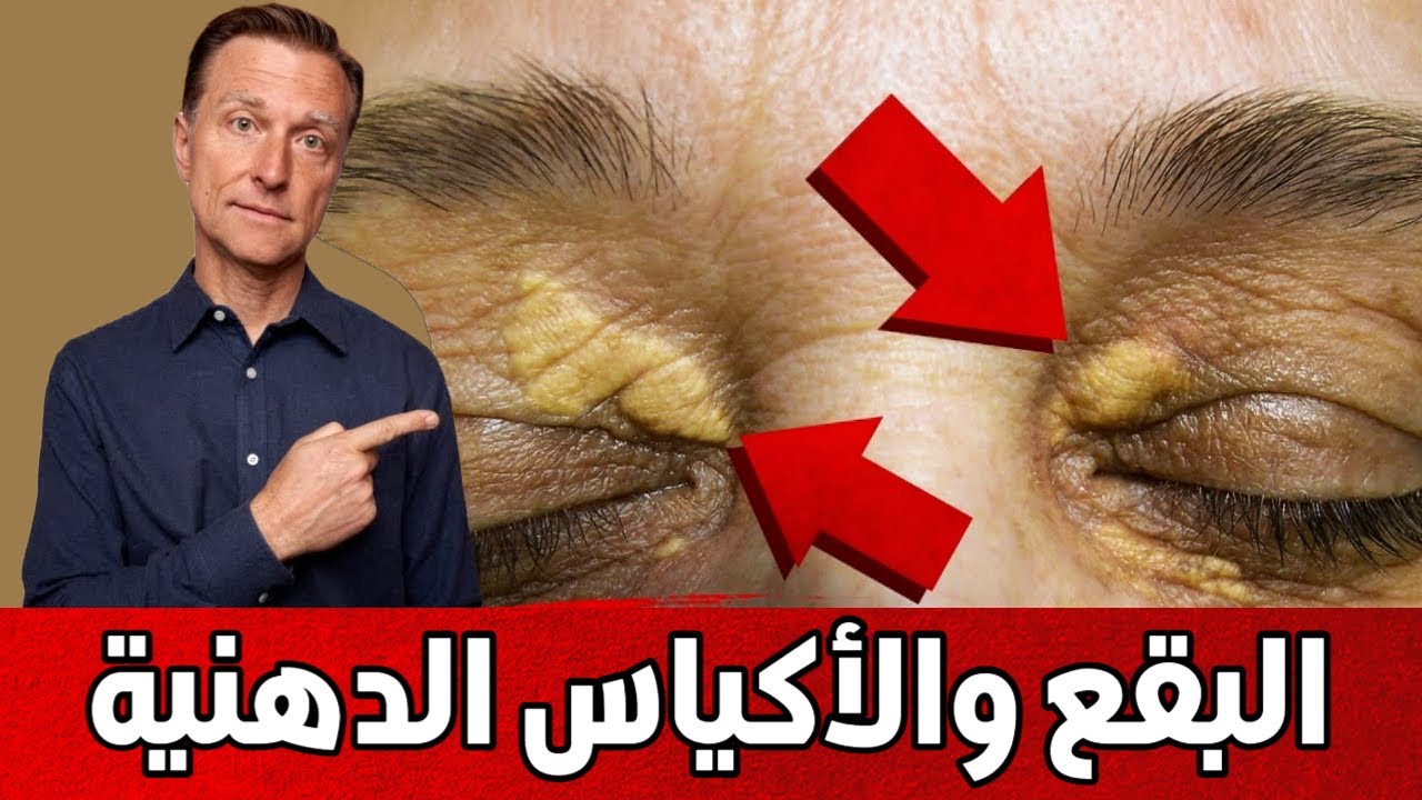 ما السبب الحقيقي لظهور هذه البقع والأكياس الدهنية في العين والجسم وكيف تتخلص منها بشكل طبيعي