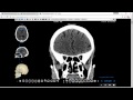 Tomografía Computada de Cabeza para Anatomía Parte 2
