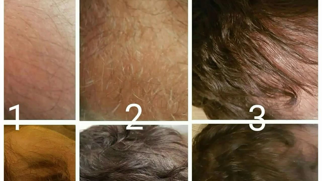 Onion juice and honey recipe which stimulate hair dense YouTube