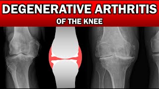 Degenerative Arthritis of the Knee #kneepain #health #medical